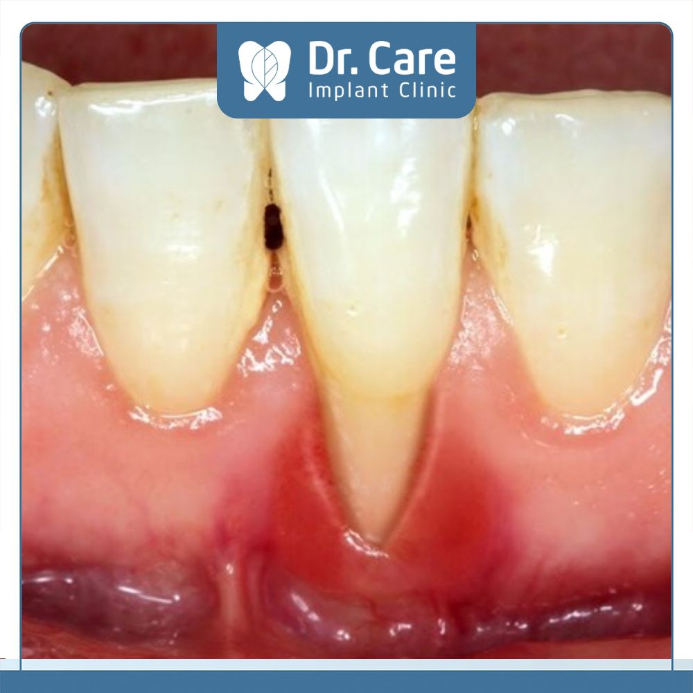 Tình trạng tụt lợi ở mức độ nặng thì trước khi bọc răng sứ Bác sĩ sẽ thăm khám và điều trị bằng các giải pháp kết hợp chuyên sâu