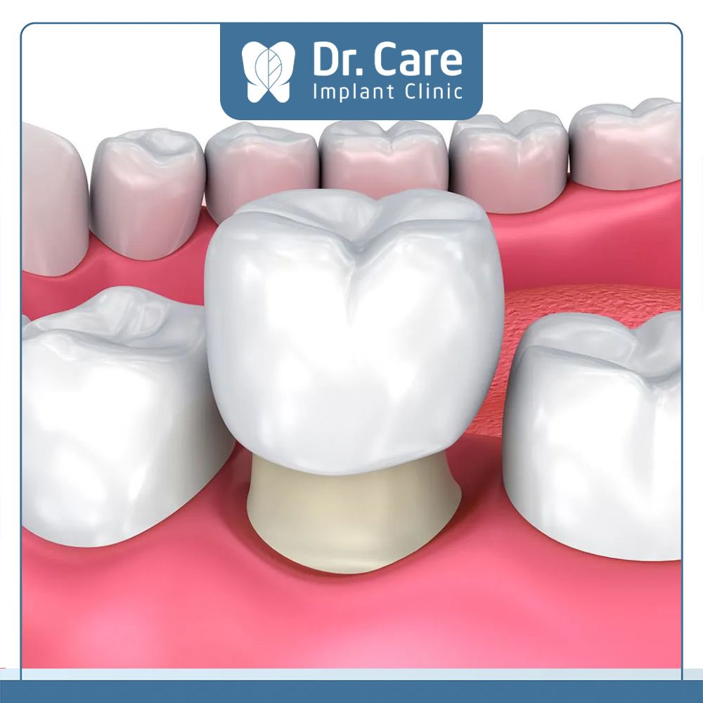 Chi phí bọc răng sứ cho người bị tụt lợi sẽ bao gồm cả chi phí chữa tụt lợi và chi phí bọc răng sứ