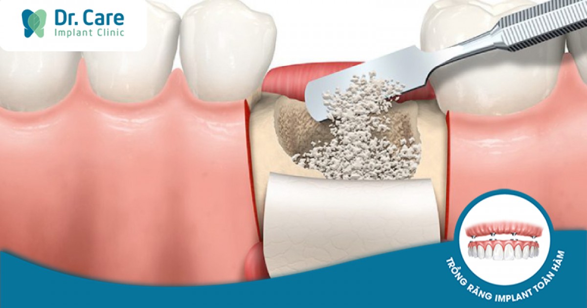 Tiêu xương răng làm ảnh hưởng đến khả năng phát âm