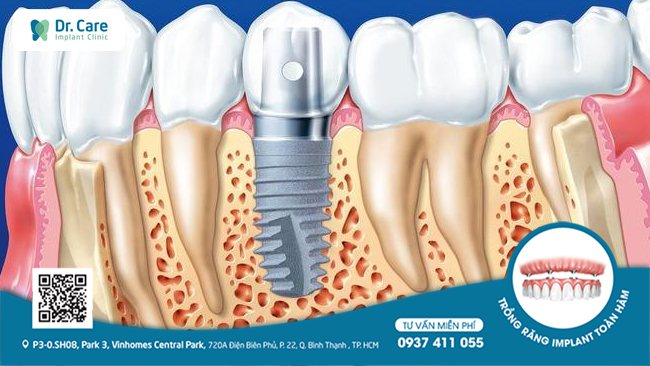 Răng Implant có thể duy trì được cấu trúc xương hàm