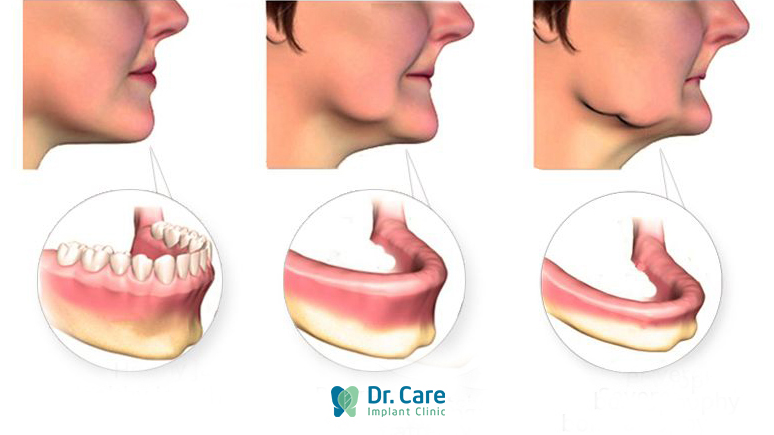 Bị móm sau khi mất răng do tiêu xương