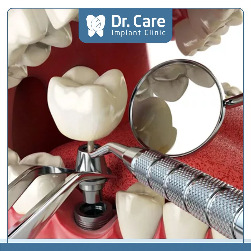 Trồng răng Implant bị sưng đau do các tác động trong quá trình phẫu thuật, cụ thể như: Tiêm, tạo vết mổ, đặt chỉ