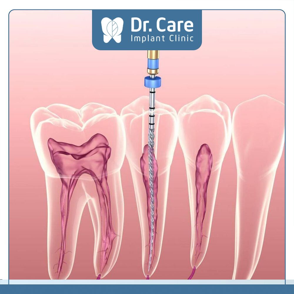 Tủy răng là loại mô liên kết có tổ chức chứa nhiều mạch máu, dây thần kinh ở hốc tủy