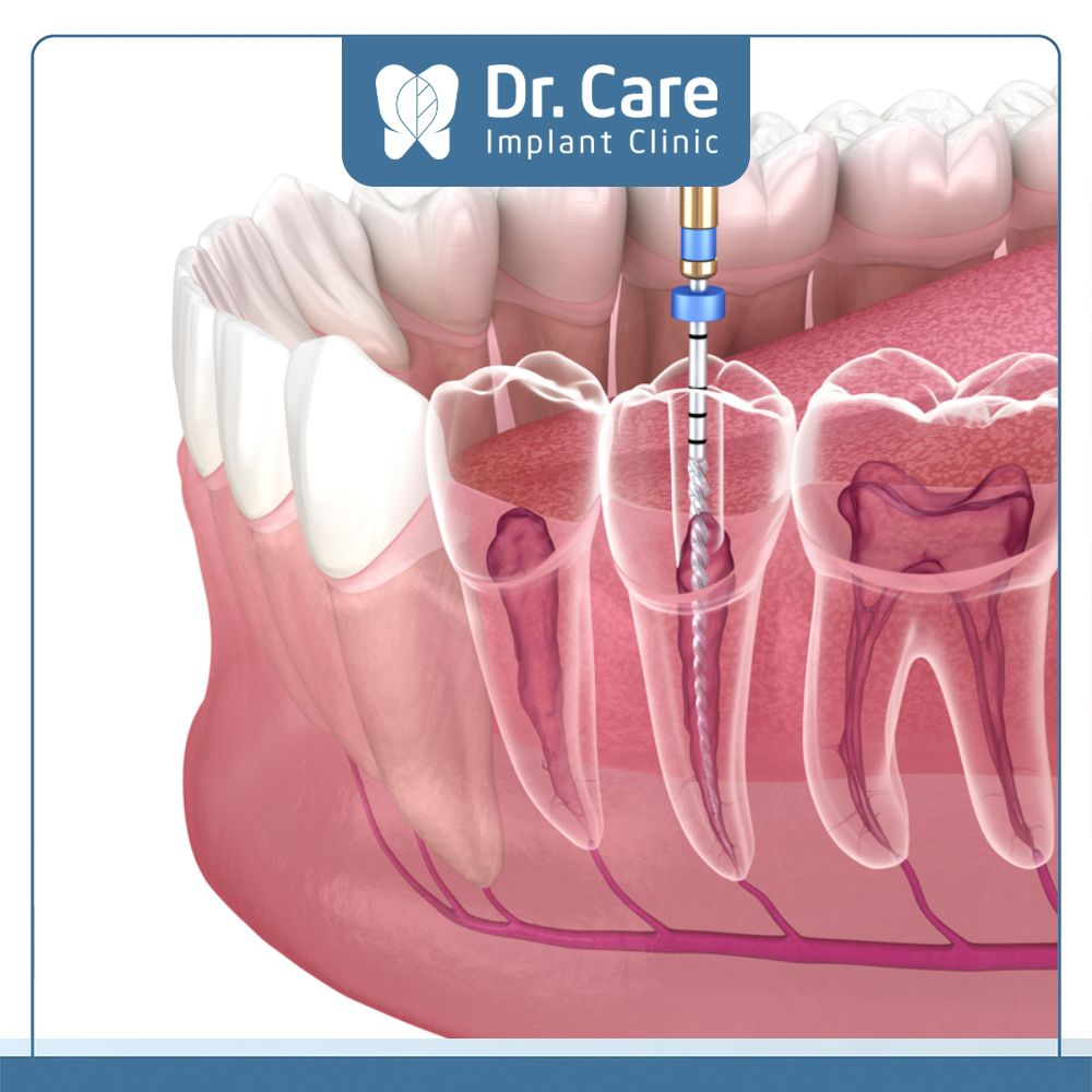Lấy tủy răng là thủ thuật nha khoa loại bỏ tủy răng bị nhiễm khuẩn dẫn đến sâu răng nặng hoặc viêm tủy