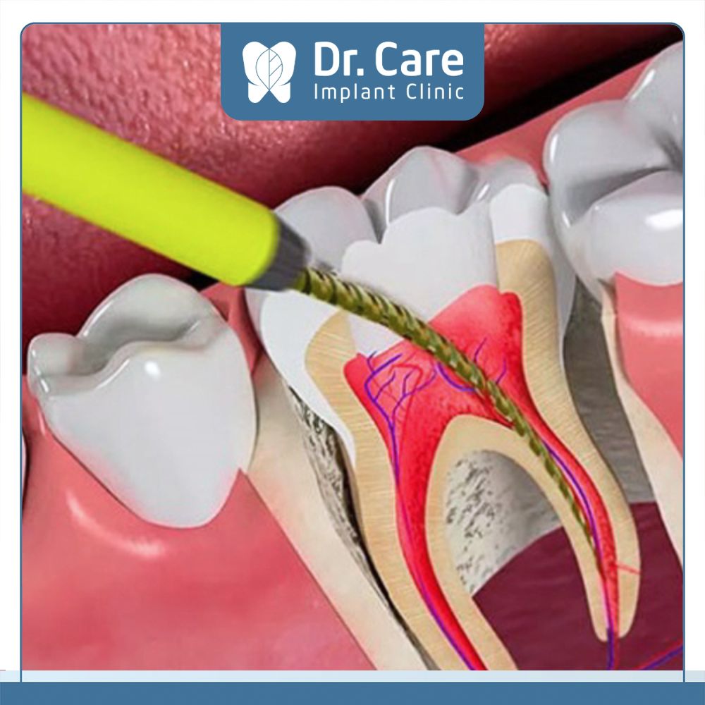 Trồng răng lấy tủy không nguy hiểm mà còn là thao tác cần thiết để ngăn chặn vấn đề sức khỏe răng miệng