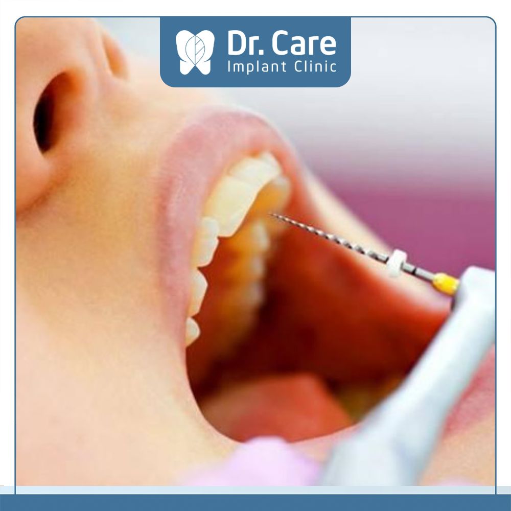 Lấy tủy răng có mức chi phí khác nhau tùy vào tình trạng răng, vị trí răng và độ tuổi điều trị 