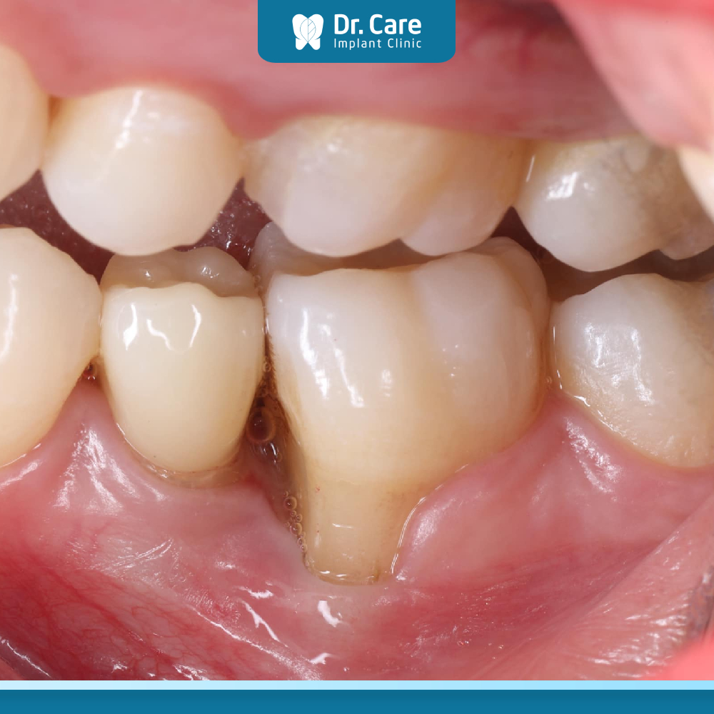 Lợi mỏng lộ chân răng có nguy hiểm không? 