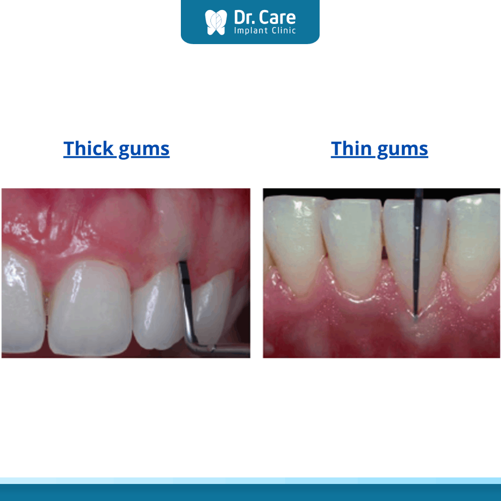 Chẩn đoán lợi mỏng lộ chân răng