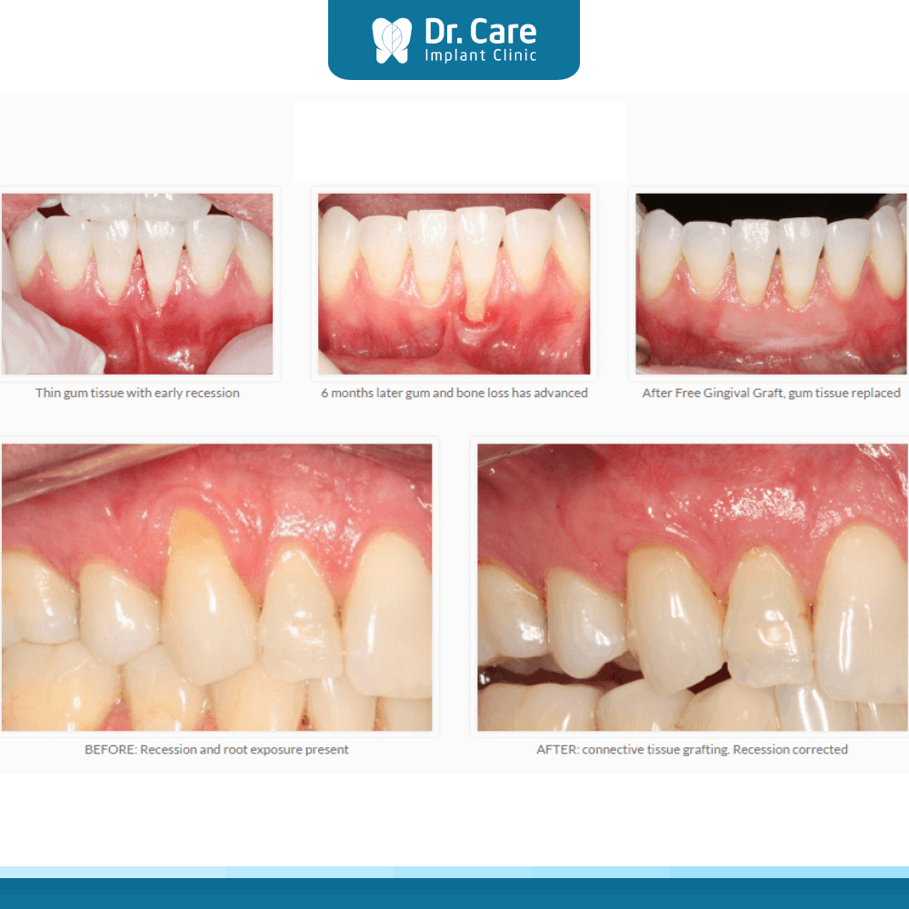 Lợi mỏng lộ chân răng là gì?