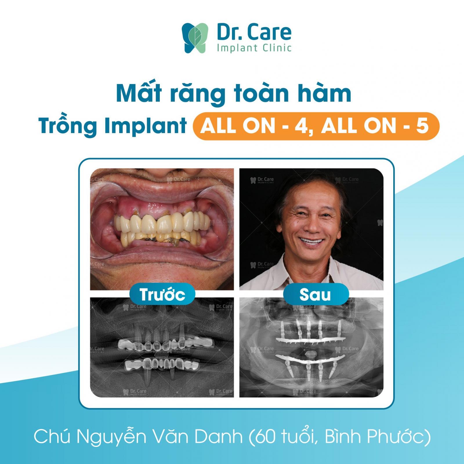 Người mất răng toàn hàm nên trồng răng Implant đơn lẻ hay cấy ghép Implant toàn hàm?