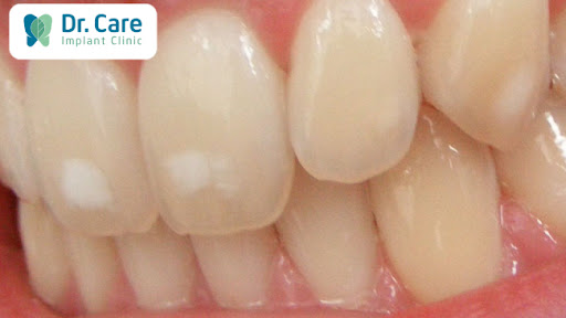 Có thể áp dụng các cách trị sâu răng tại nhà không cần đến nha khoa không?