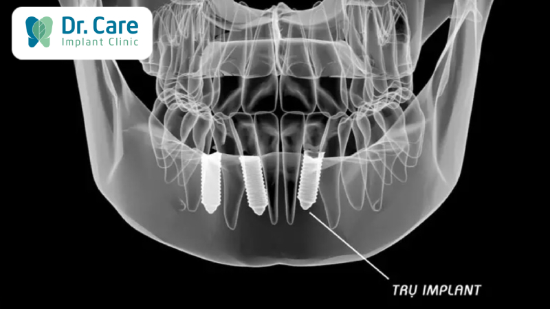 Khắc phục hậu quả mất răng do điều trị áp xe răng không kịp thời