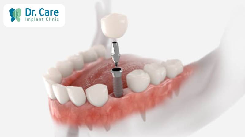 Phục hồi răng đã mất do áp xe răng bằng phương pháp Implant