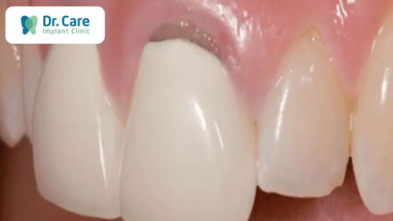 8 Tác hại bọc răng sứ giá rẻ