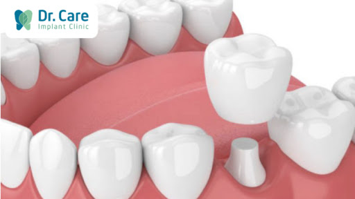 Phương pháp bọc răng sứ là gì?