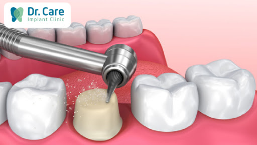 Quy trình bọc răng sứ cho răng sâu: