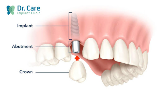 Trồng răng Implant - giải pháp mất răng nào trồng răng đó