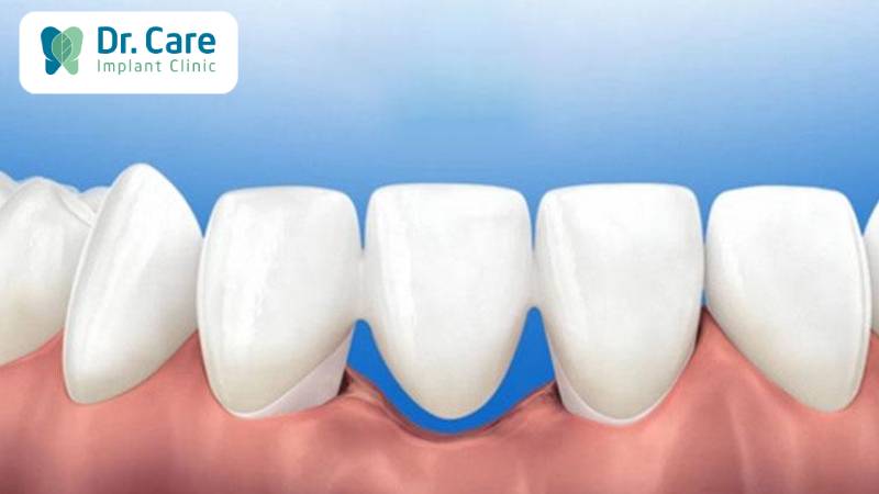 Làm cầu răng sứ bao lâu thì xương hàm bị tiêu đi
