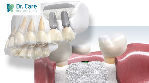 5 cách tiết kiệm chi phí trồng răng Implant khi mất răng