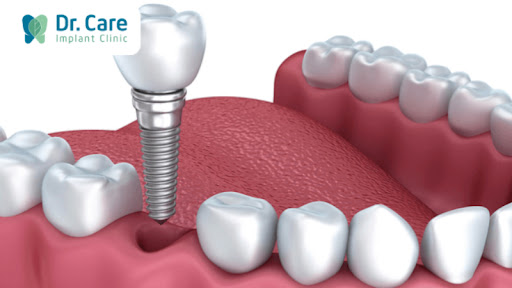 Ưu điểm của phương pháp trồng răng Implant