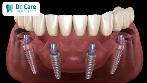 Trồng răng Implant toàn hàm khi mất hết răng