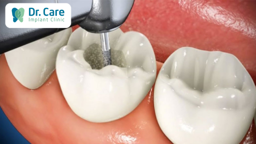 Lấy tủy răng trước khi bọc răng sứ có gây ảnh hưởng gì không? 