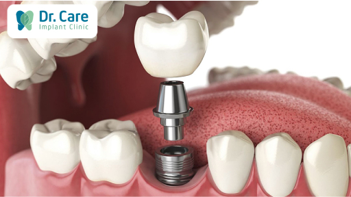 Khắc phục tình trạng mất răng sau khi chữa tủy bằng phương pháp trồng răng Implant