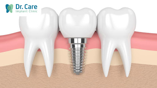 Trồng răng Implant - Giải pháp sau khi nhổ răng đã lấy tủy