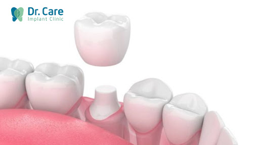 Điều trị nội nha trong trường hợp sâu răng ăn vào tủy