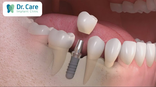 Trồng răng Implant