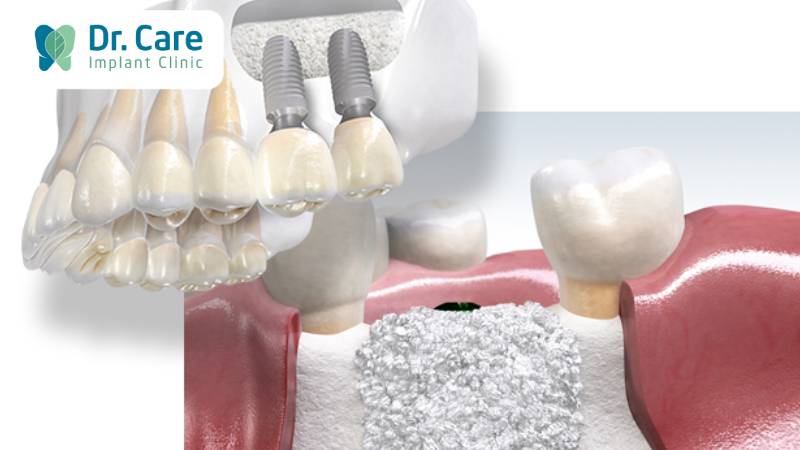 Trồng răng Implant trong trường hợp mất răng lâu năm