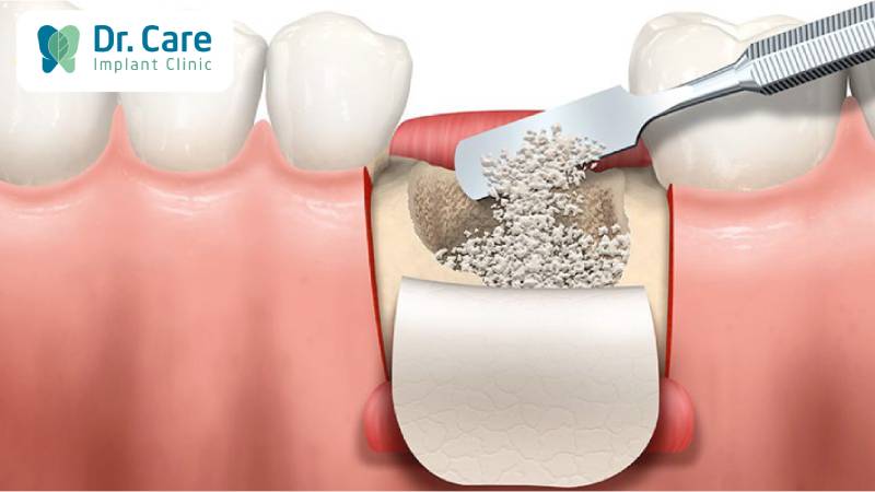 Tại sao cần phải ghép xương trước khi trồng răng implant?