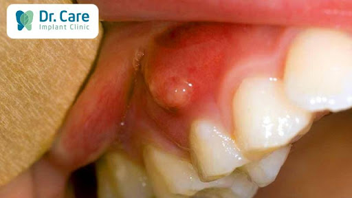 Trường hợp mắc các bệnh lý răng miệng làm chất lượng xương răng bị ảnh hưởng