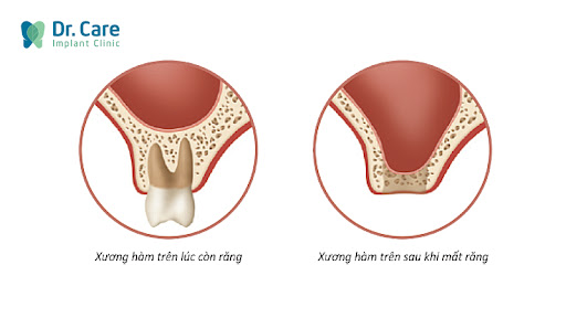 Lý do cần phải ghép xương trước khi trồng răng implant