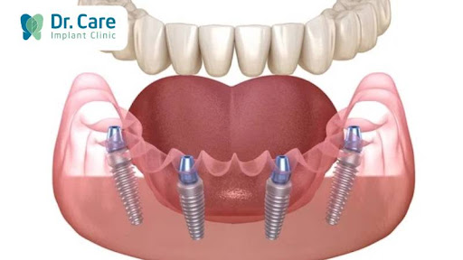 Trồng răng Implant toàn hàm All on 4 là gì?