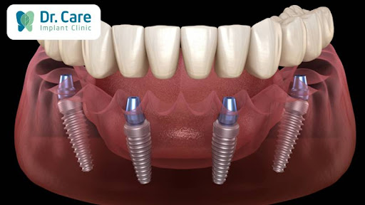 Chi phí trồng răng Implant phục hồi mất răng toàn hàm
