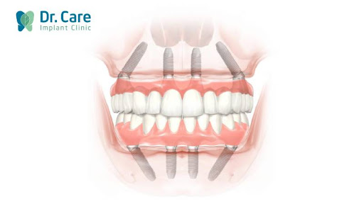 Ưu điểm của Trồng răng Implant toàn hàm All on 4