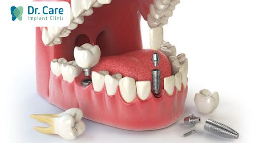 Ưu điểm trồng răng Implant phục hồi răng đã mất
