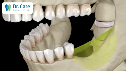 Răng lấy tủy có bị tiêu xương không? 