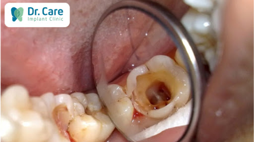 Nhiễm trùng răng là gì? 
