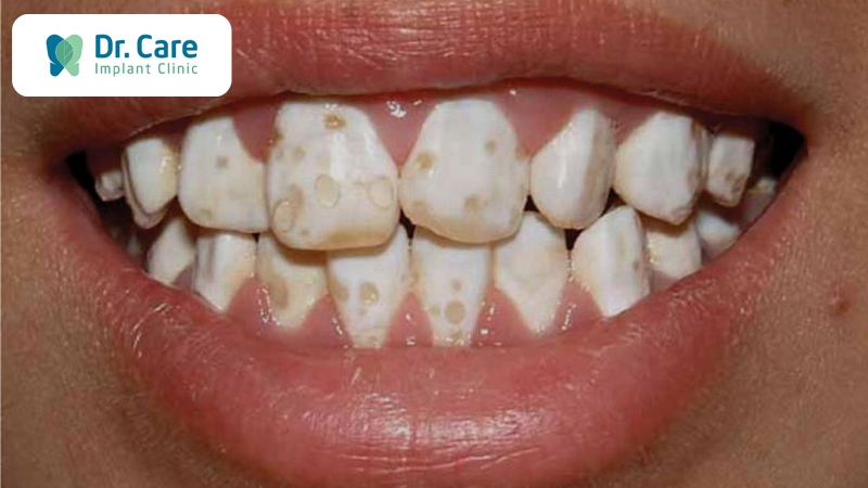 Rụng răng do chế độ dinh dưỡng không đảm bảo
