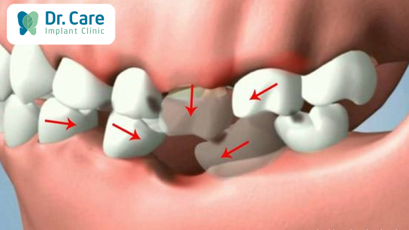 Mất răng gây ảnh hưởng các răng còn lại