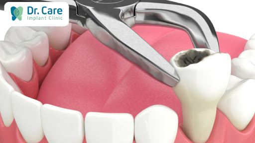 Nhổ răng có ảnh hưởng gì không?