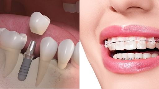 Mất răng nên niềng răng hay trồng răng implant?