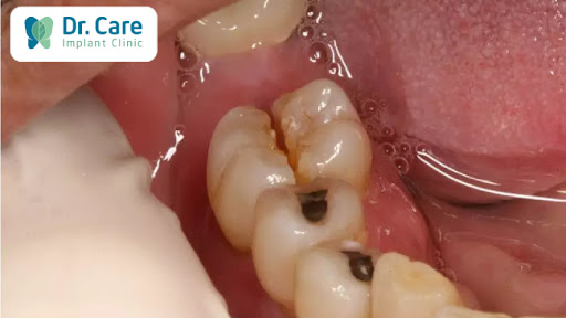 Nứt dọc thân răng có nguy hiểm không?