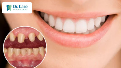 Tại sao cần một quy trình bọc răng sứ thẩm mỹ chuẩn