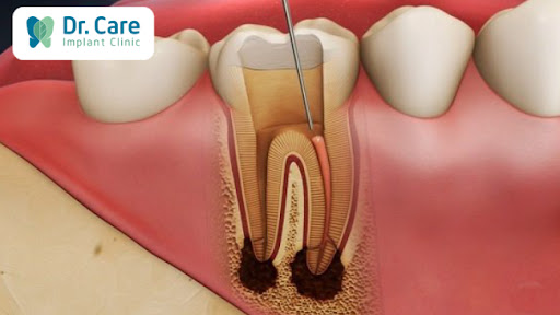 Tại sao cần một quy trình bọc răng sứ thẩm mỹ chuẩn