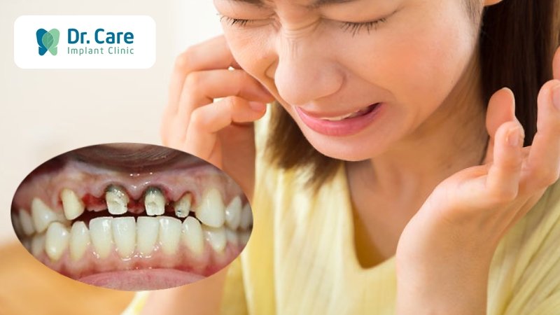 Răng mục nát sau khi bọc răng sứ là gì? Vì sao cần điều trị răng mục nát sớm?