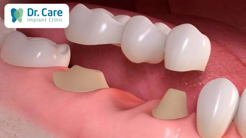 Phương pháp cầu răng sứ là gì?