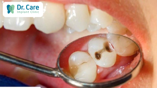 Bệnh lý răng miệng và nguy cơ mất răng